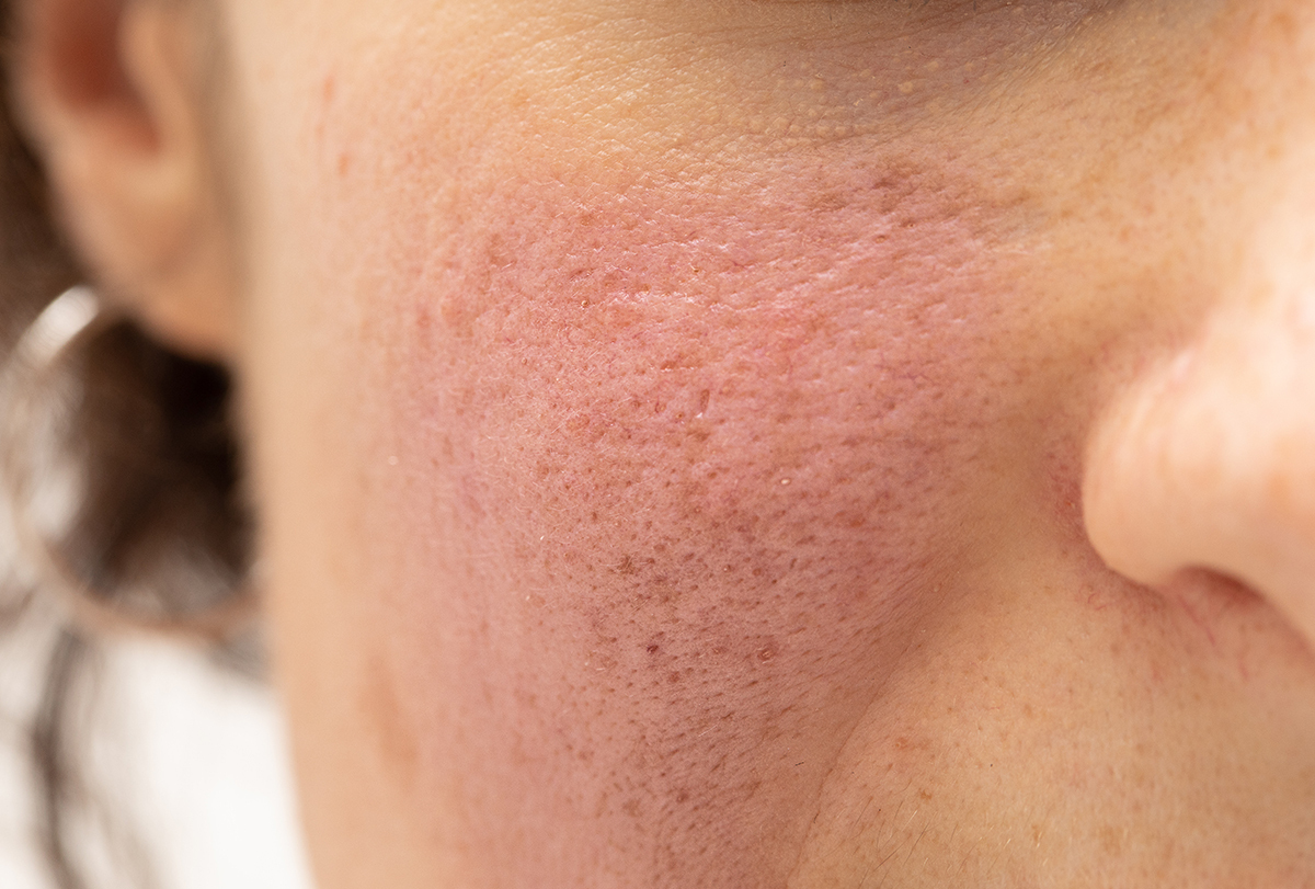 Best Way to Get Rid of Redness on Face Overnight