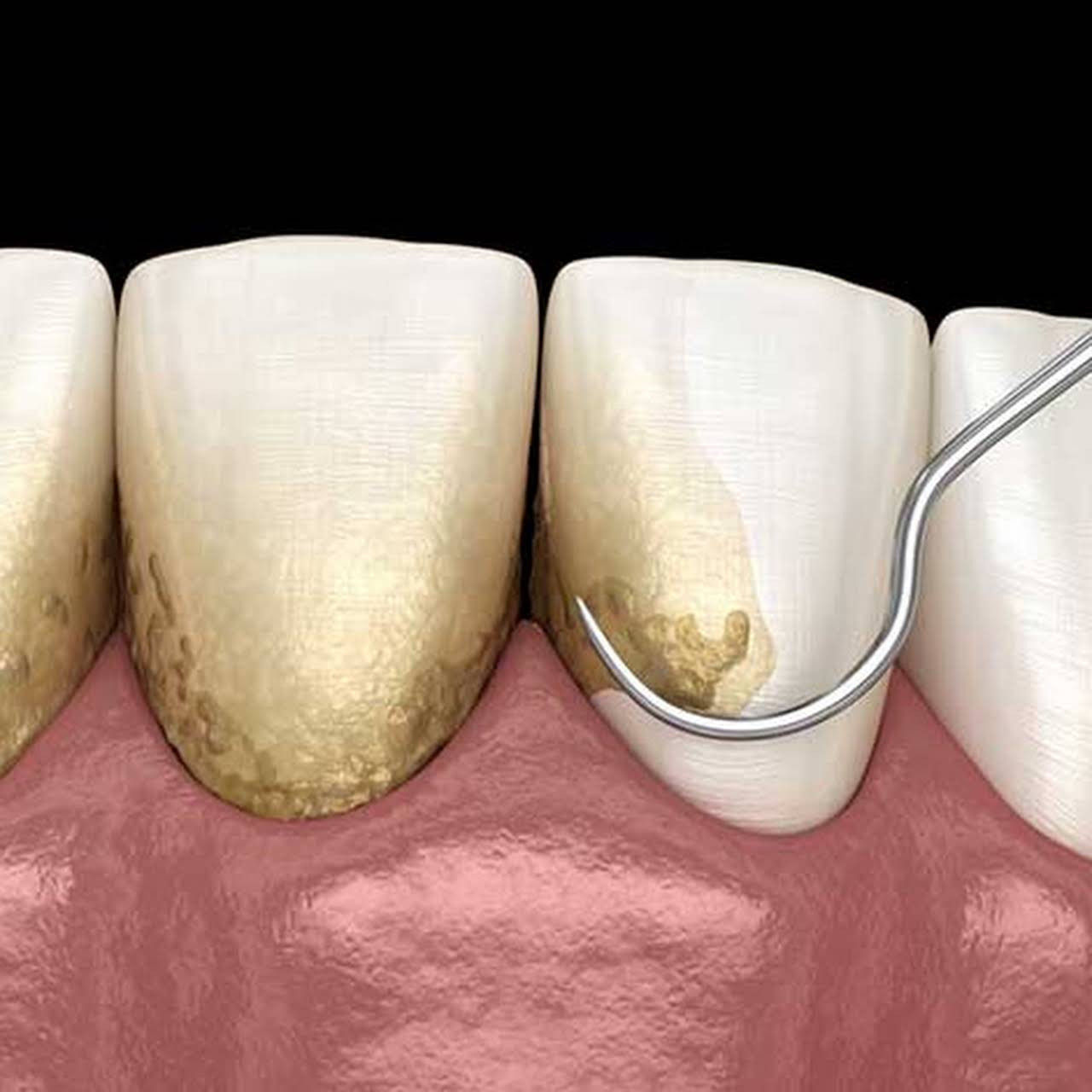 Can Natural Remedies Remove Tartar from teeth