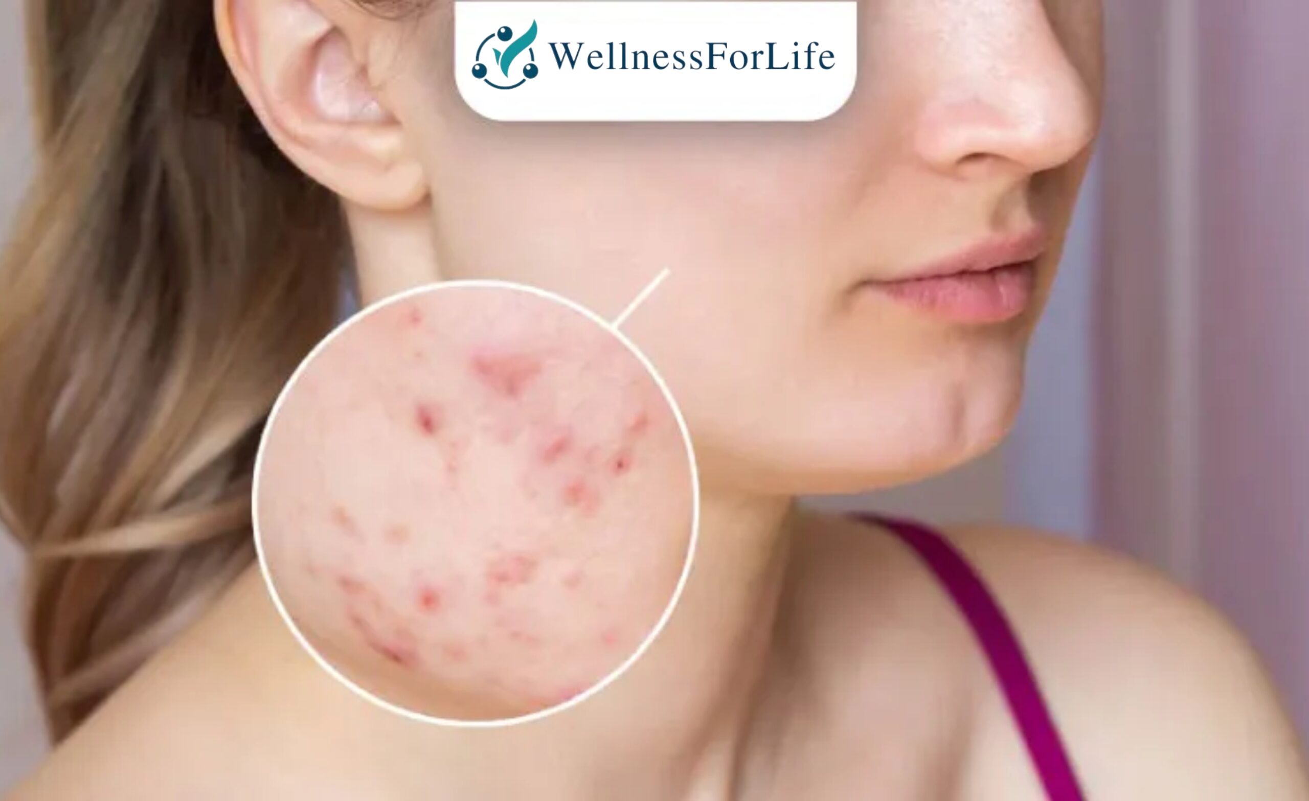 Fungal Acne